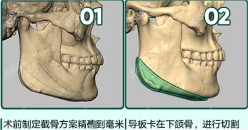 沈绍勇医生擅长磨骨