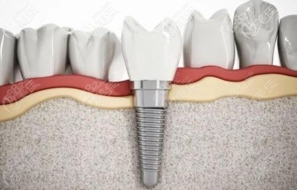 深圳同步齿科瑞士ITI种植牙怎么样