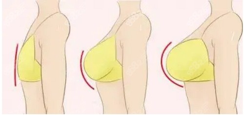 广州尹卫东隆胸间距宽吗 广州尹卫东隆胸间距宽吗