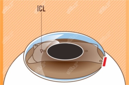 眼睛晶体植入手术示意图