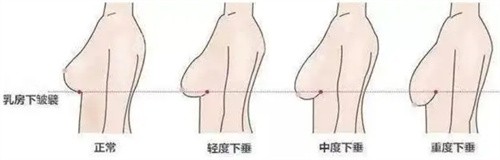 重庆乳房下垂矫正医生哪个好