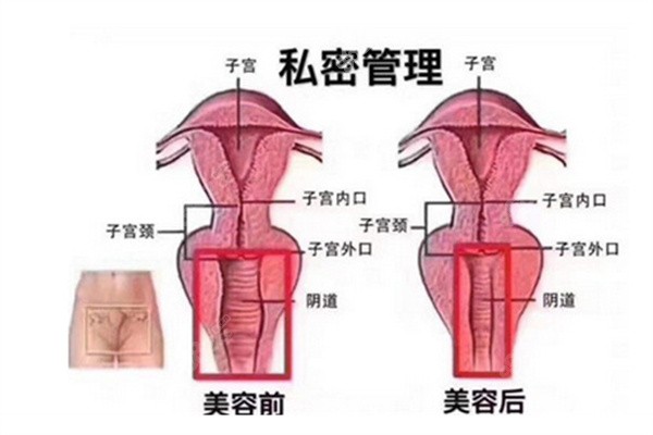 八爪鱼紧缩术后多久能性生活