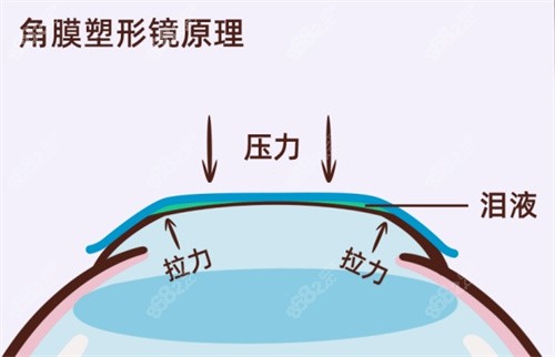 揭秘国内角膜塑形镜价格！含梦戴维/普诺瞳/亨泰等品牌价格