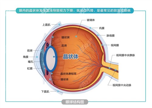 白内障手术注意事项