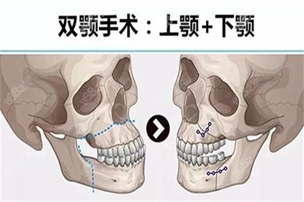 王涛正颌手术多少钱