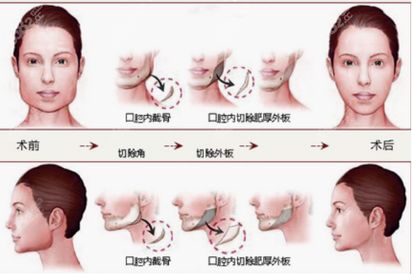 重庆王涛正颌手术费用是多少