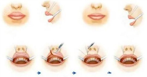 厚唇改薄手术示意图