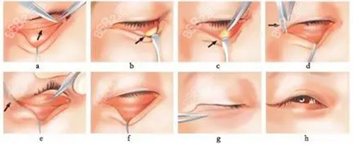去眼袋手术方法