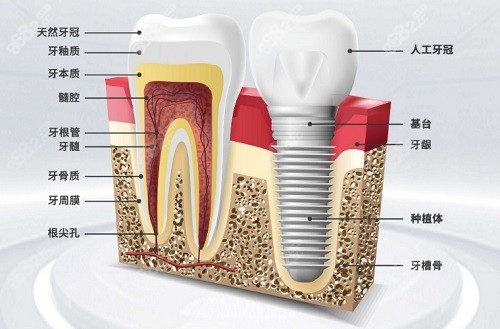成都新桥口腔医院种植牙收费标准