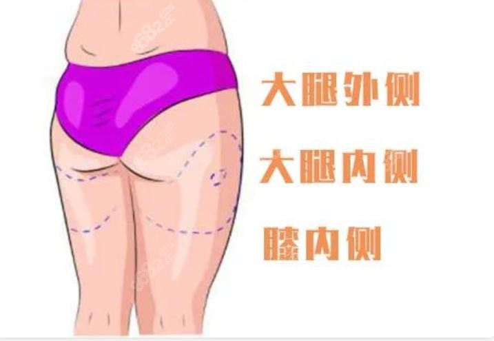 大腿吸脂