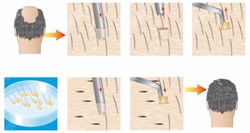 江苏百年植发毛发移植示意图