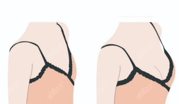 武漢徐國建隆胸口碑實例分享