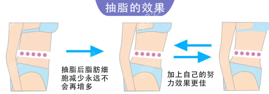 孙延辉吸脂实例成效图：