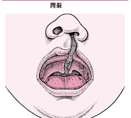【国内唇裂医生排行榜前十名】含唇裂二期修复好医生介绍