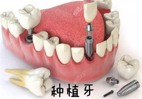 银川和仁堂口腔数字化导板种植牙优惠