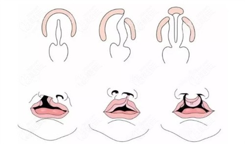 国内唇裂医院排行榜前十