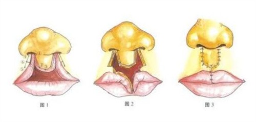 四川现代医院整形修复外科唇裂医生推荐