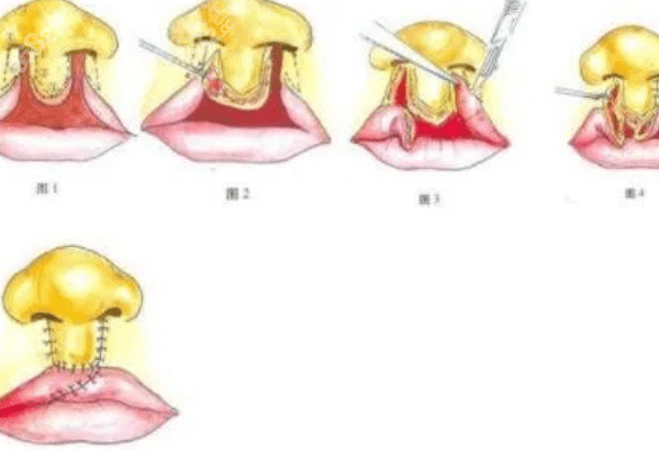 广州高尚医疗美容医院余文林医生唇裂手术真实病例分享