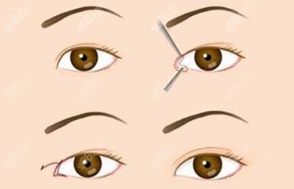 呂方中做雙眼皮避雷?測(cè)評(píng)呂方中雙眼皮失敗修復(fù),原來(lái)是被黑