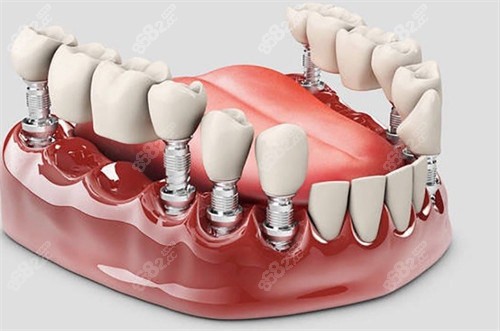 （五）半口/全口種植方案詳解