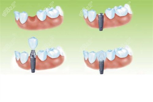 團圓口腔2025種植牙價格表：