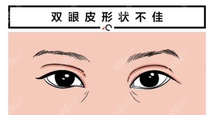 呂方中做雙眼皮避雷?測(cè)評(píng)呂方中雙眼皮失敗修復(fù),原來(lái)是被黑