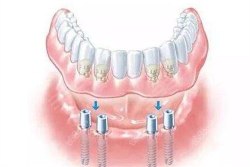 （三）瑞士ITI種植體價格：5800元起；
