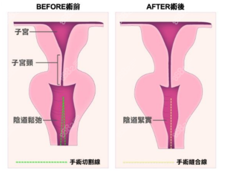 妇科私密医生24小时在线解答:在线预约紧缩针|阴唇修复