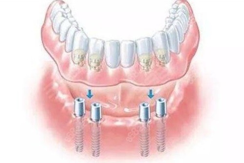 长沙中诺口腔医院全口种植牙