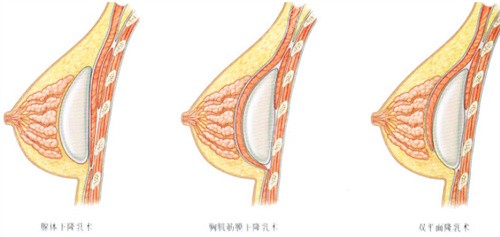 隆胸假体植入层次