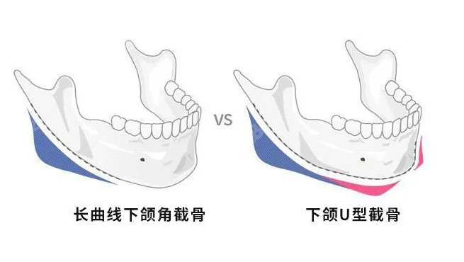 上海做下颌角手术医生推荐表前20