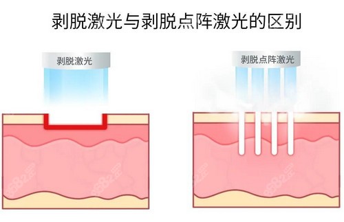 武汉点阵激光哪家好