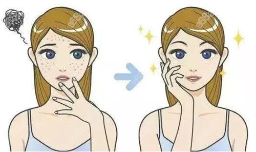 激光祛斑在線答疑