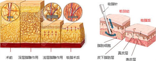 八、华美整形吸脂患者评价：口碑见证，值得信赖