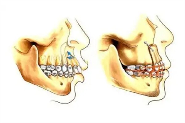 小下颌畸形手术风险大吗