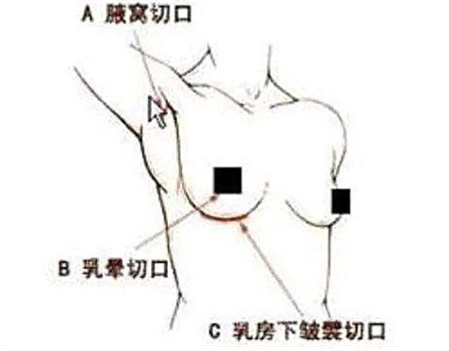 假体隆胸手术切口位置