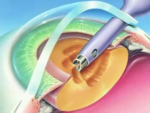 成都近视手术价格一览表2025:含全飞秒|半飞秒|激光手术价格