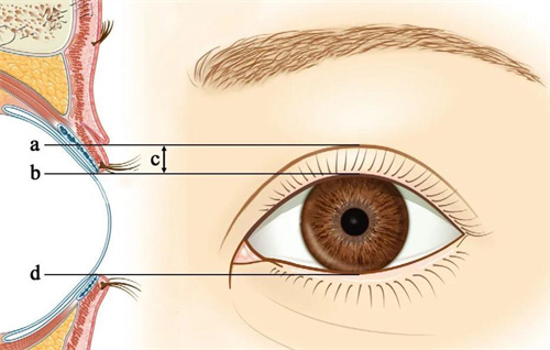 厦门薇格做眼睛可以吗？薇格原生美眼可塑造妈生感双眼皮