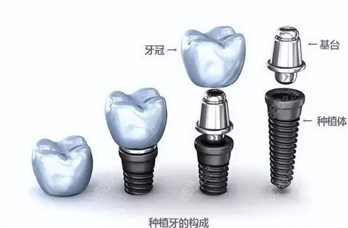 2025鼎植口腔医院医院基础治疗价格表：