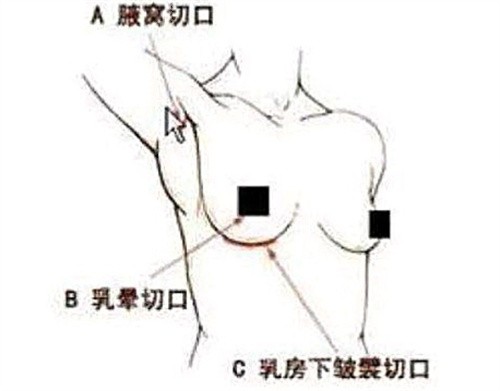隆胸手术切口位置