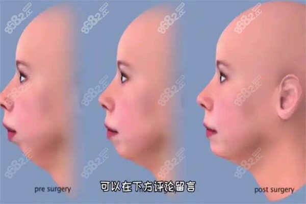 柳春明做凸嘴特色