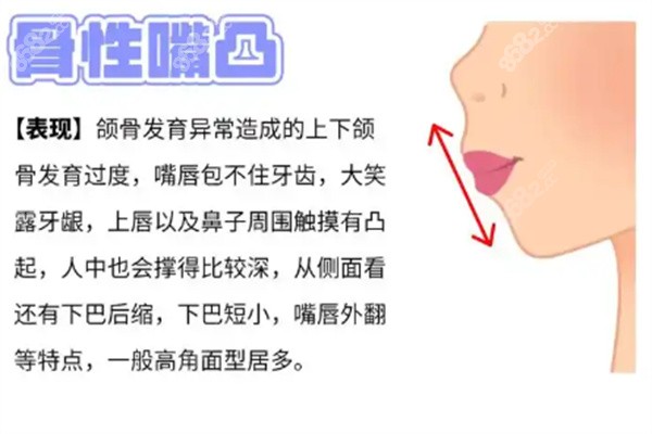柳春明怎么样做突嘴