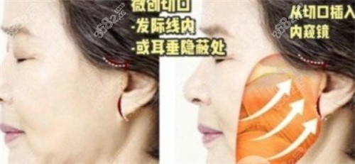 国内拉皮手术医生排名前十穆宝安医生