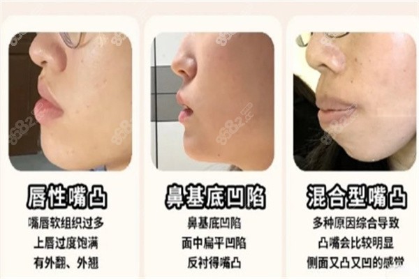北京柳春明凸嘴费用6W值