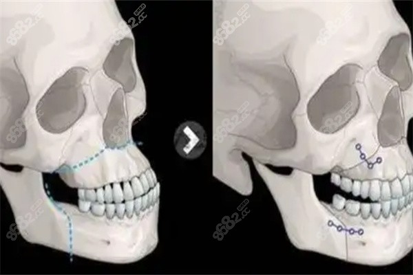 柳春明匀梯度凸嘴手术痛苦吗