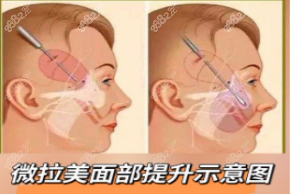 北京微拉美面部提