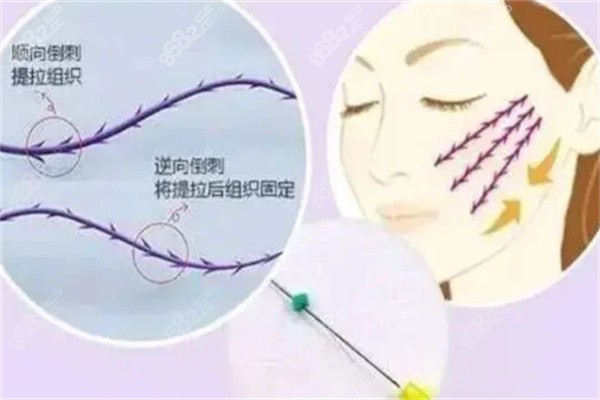 微拉美面部提升多少錢