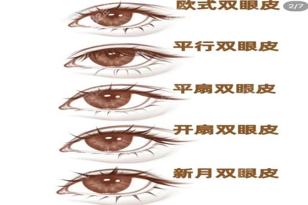 郑州东方整形医院做双眼皮手术