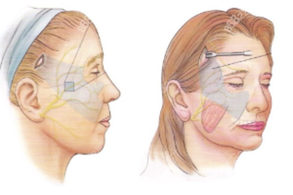 微拉美面部提升手術(shù)