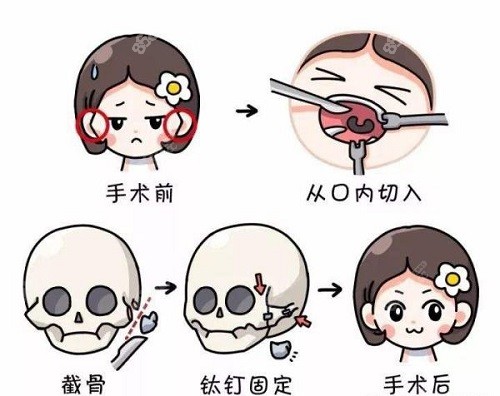 颧骨内推价格参考